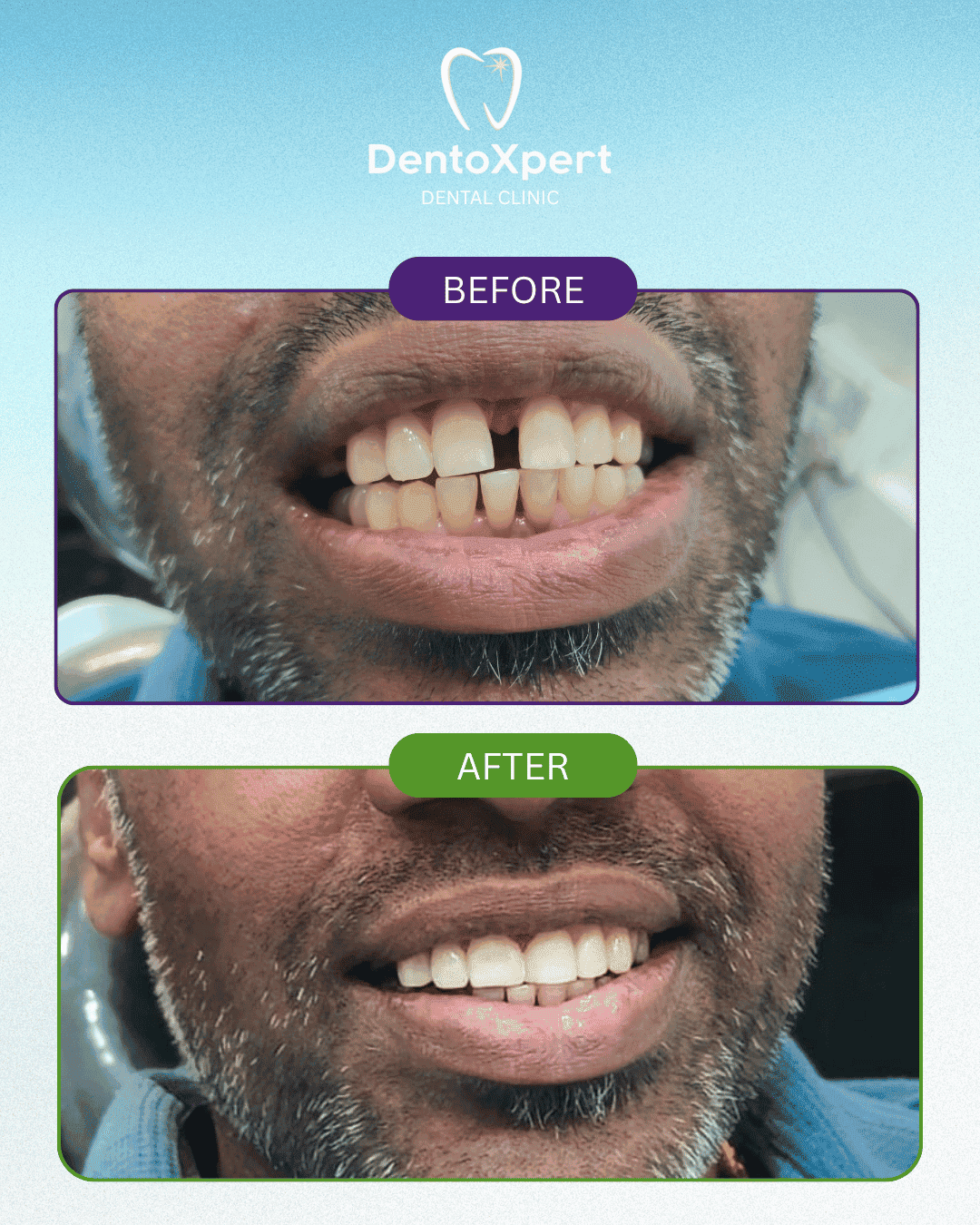 Before and after dental treatment result at DentoXpert Dental Clinic in Thane